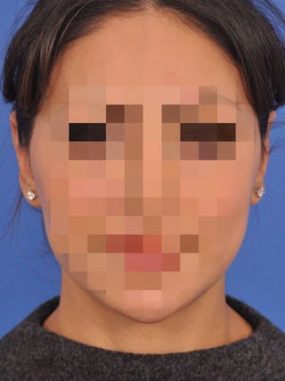 Otoplasty Before & After Gallery - Patient 404825 - Image 2