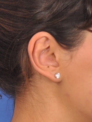 Otoplasty Before & After Gallery - Patient 404825 - Image 6