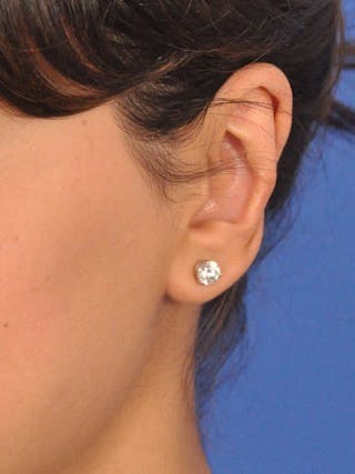 Otoplasty Before & After Gallery - Patient 404825 - Image 8