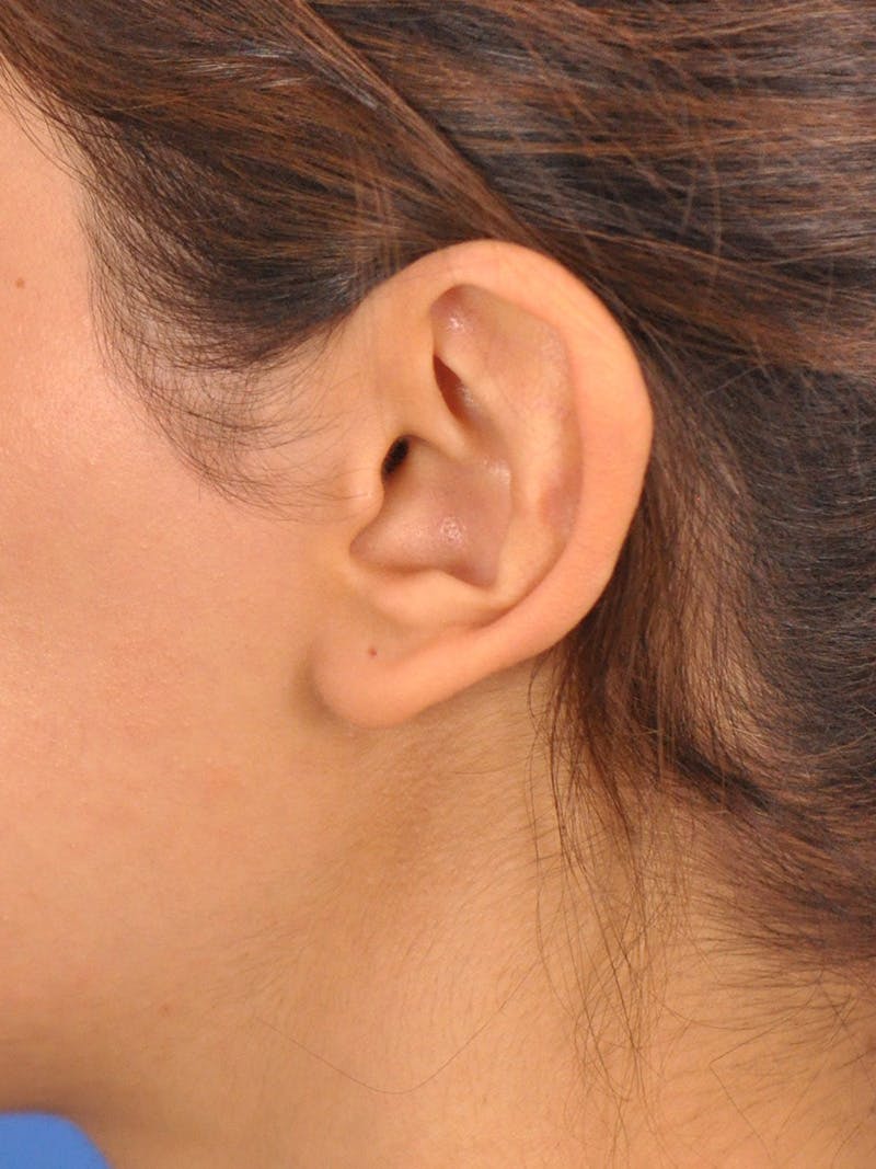 Otoplasty Before & After Gallery - Patient 404825 - Image 9