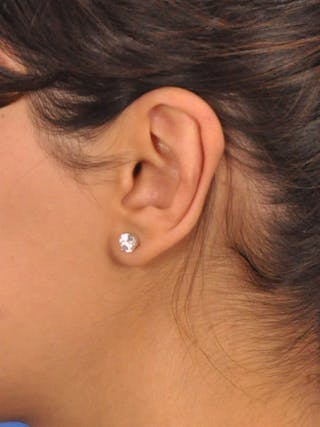 Otoplasty Before & After Gallery - Patient 404825 - Image 10