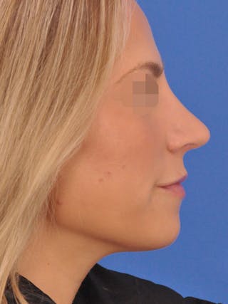 Rhinoplasty Before & After Gallery - Patient 277325 - Image 2