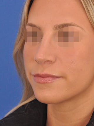 Rhinoplasty Before & After Gallery - Patient 277325 - Image 4