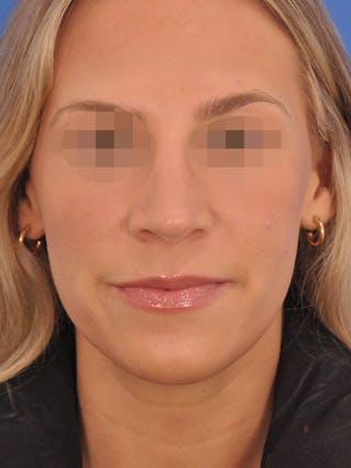 Rhinoplasty Before & After Gallery - Patient 277325 - Image 6