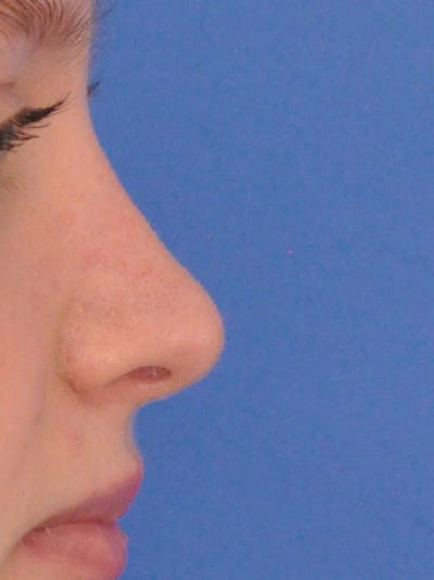 Rhinoplasty Before & After Gallery - Patient 191516 - Image 2