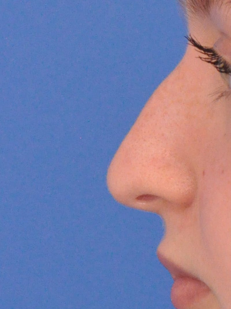 Rhinoplasty Before & After Gallery - Patient 191516 - Image 3