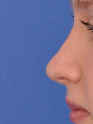 Rhinoplasty Before & After Gallery - Patient 191516 - Image 4