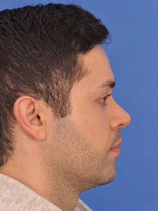 Rhinoplasty Before & After Gallery - Patient 376047 - Image 2