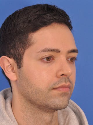 Rhinoplasty Before & After Gallery - Patient 376047 - Image 4
