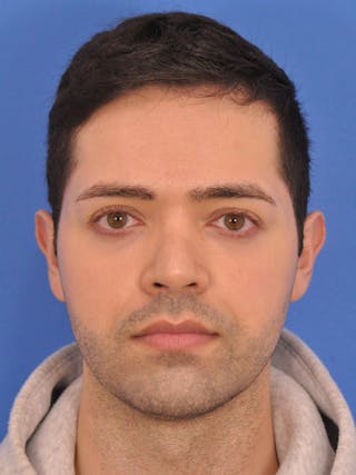 Rhinoplasty Before & After Gallery - Patient 376047 - Image 6