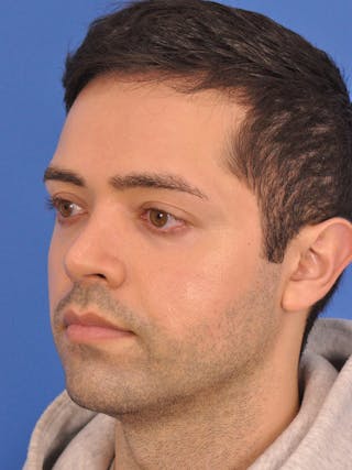 Rhinoplasty Before & After Gallery - Patient 376047 - Image 8