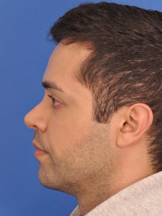 Rhinoplasty Before & After Gallery - Patient 376047 - Image 10