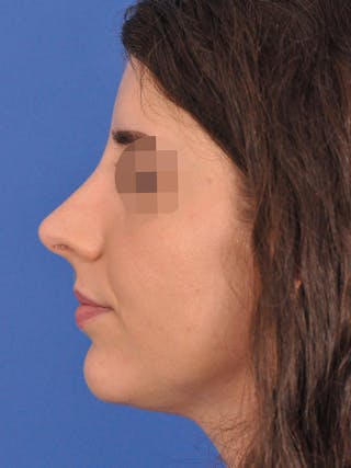 Rhinoplasty Before & After Gallery - Patient 261277 - Image 2