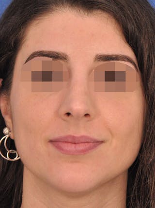 Rhinoplasty Before & After Gallery - Patient 261277 - Image 4