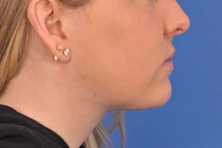 Neck Lift Before & After Gallery - Patient 286024 - Image 2