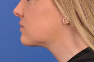 Neck Lift Before & After Gallery - Patient 286024 - Image 4