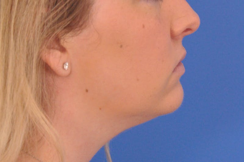 Neck Lift Before & After Gallery - Patient 286024 - Image 1