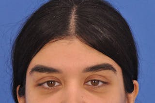 Brow Lift Before & After Gallery - Patient 355158 - Image 2