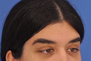 Brow Lift Before & After Gallery - Patient 355158 - Image 4