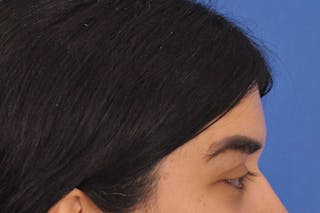 Brow Lift Before & After Gallery - Patient 355158 - Image 6