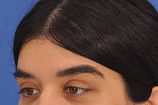 Brow Lift Before & After Gallery - Patient 355158 - Image 8