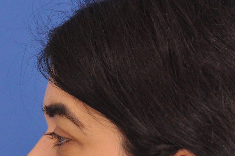 Brow Lift Before & After Gallery - Patient 355158 - Image 9