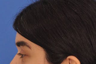 Brow Lift Before & After Gallery - Patient 355158 - Image 10