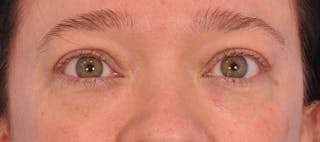 Blepharoplasty Before & After Gallery - Patient 307574 - Image 2