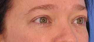 Blepharoplasty Before & After Gallery - Patient 307574 - Image 4