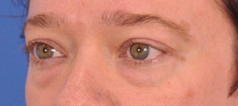 Blepharoplasty Before & After Gallery - Patient 307574 - Image 5