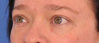 Blepharoplasty Before & After Gallery - Patient 307574 - Image 6