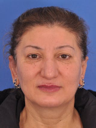 Otoplasty Before & After Gallery - Patient 100831 - Image 2