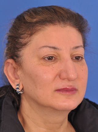 Otoplasty Before & After Gallery - Patient 100831 - Image 4