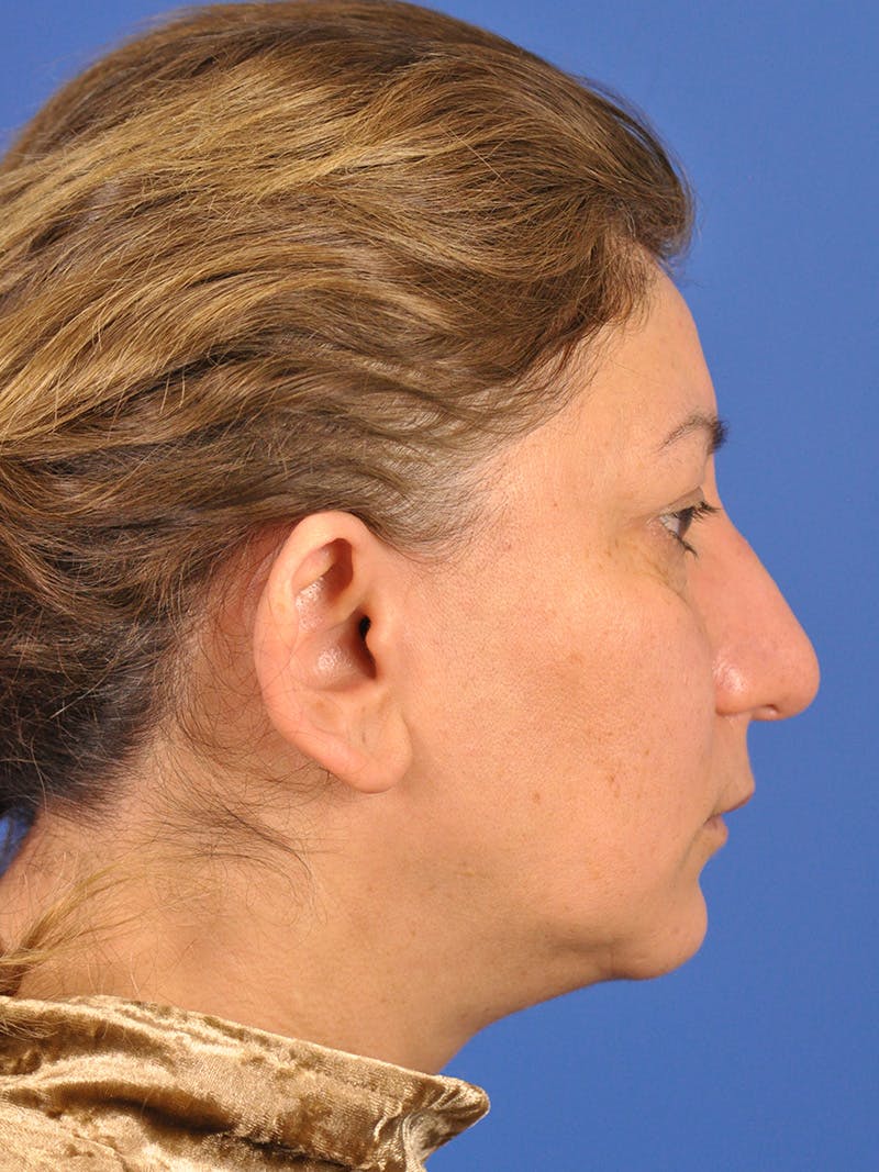 Otoplasty Before & After Gallery - Patient 100831 - Image 5