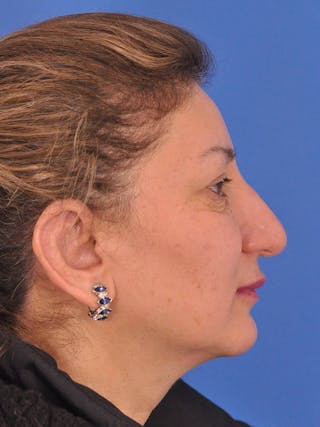 Otoplasty Before & After Gallery - Patient 100831 - Image 6