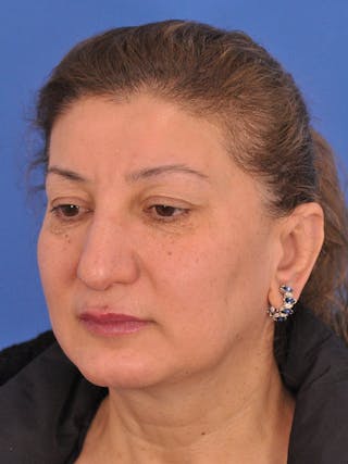 Otoplasty Before & After Gallery - Patient 100831 - Image 8