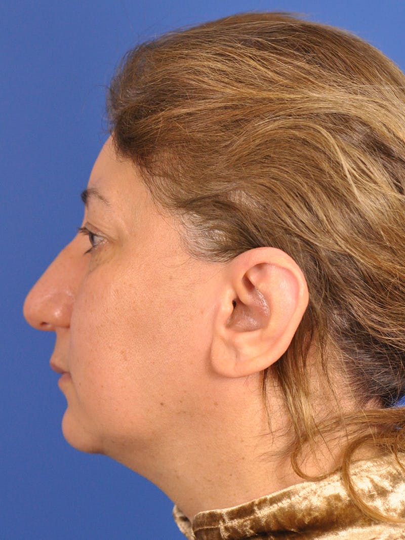 Otoplasty Before & After Gallery - Patient 100831 - Image 9