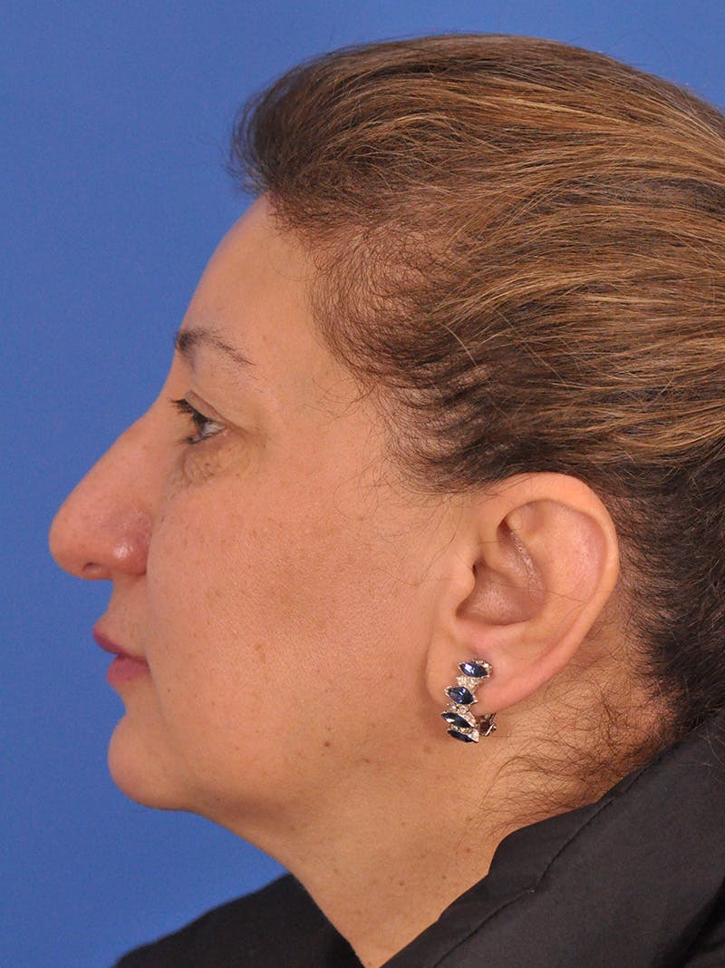 Otoplasty Before & After Gallery - Patient 100831 - Image 10