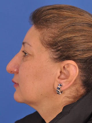 Otoplasty Before & After Gallery - Patient 100831 - Image 10