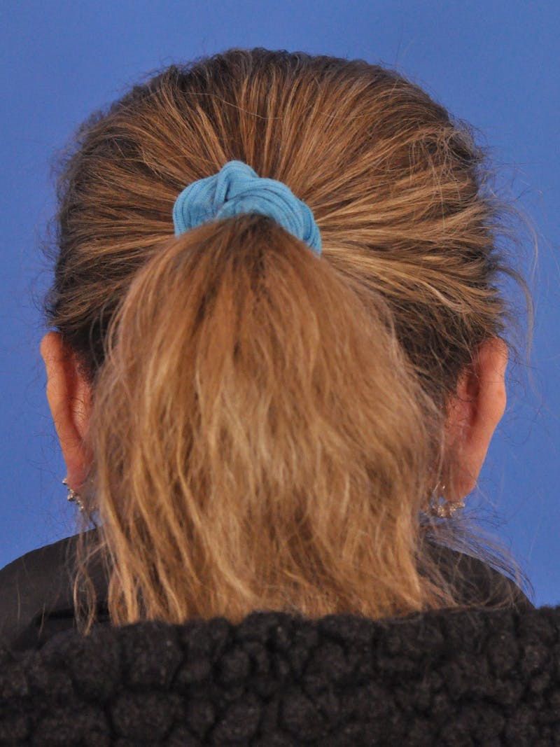 Otoplasty Before & After Gallery - Patient 100831 - Image 12