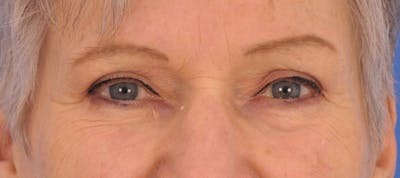 Blepharoplasty Before & After Gallery - Patient 211393 - Image 2