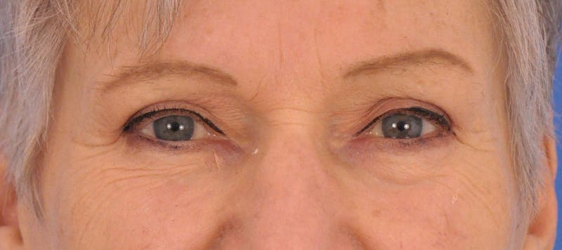 Blepharoplasty Before & After Gallery - Patient 211393 - Image 2