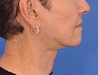 Neck Lift Before & After Gallery - Patient 324186 - Image 2