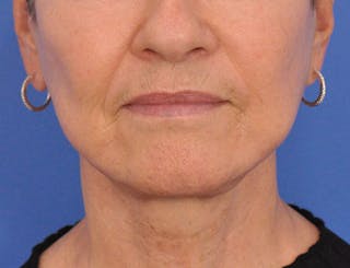 Neck Lift Before & After Gallery - Patient 324186 - Image 4