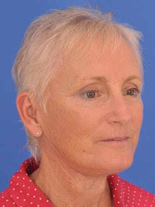 Facelift Before & After Gallery - Patient 846446 - Image 2