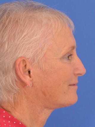Facelift Before & After Gallery - Patient 846446 - Image 4