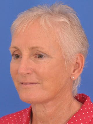 Facelift Before & After Gallery - Patient 846446 - Image 6