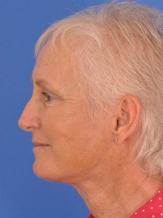 Facelift Before & After Gallery - Patient 846446 - Image 8