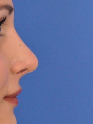 Rhinoplasty Before & After Gallery - Patient 377869 - Image 2