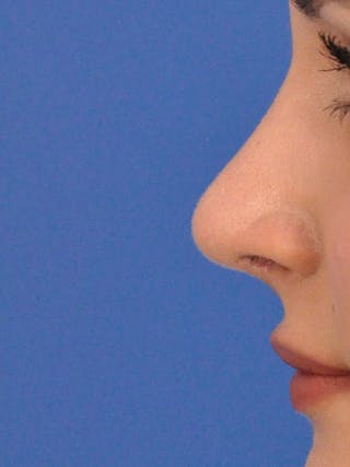 Rhinoplasty Before & After Gallery - Patient 377869 - Image 4